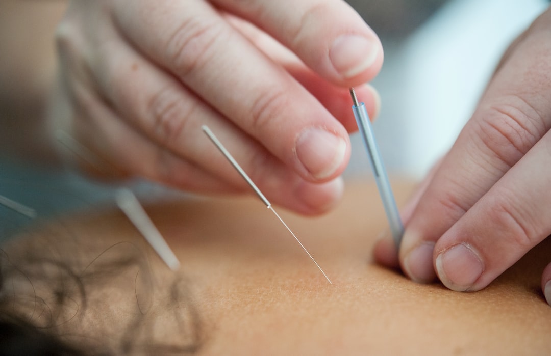 The Art of Acupuncture: Demystifying the Ancient Practice and Its Benefits for Modern Living